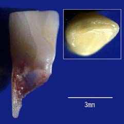 乳歯切歯のデジカメ像