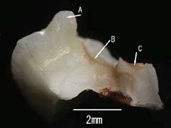 虫歯の断面写真